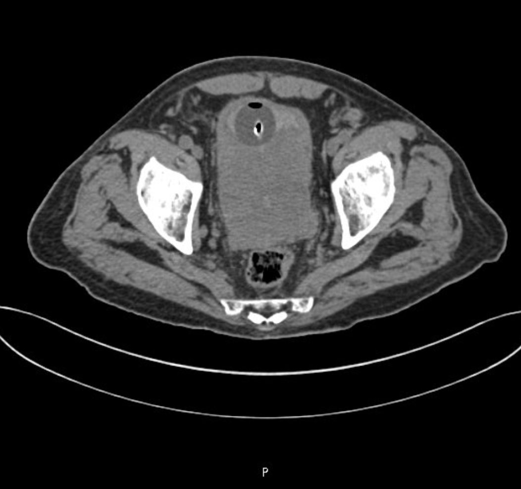 Tomografía Axial